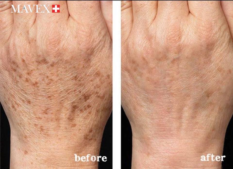 MAVEX Rankų serumas nuo tamsių dėmių, 50ml